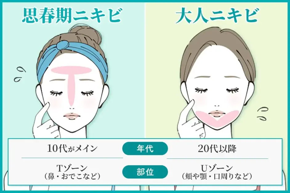 画像に alt 属性が指定されていません。ファイル名: %E3%83%8B%E3%82%AD%E3%83%93%E5%8C%96%E7%B2%A7%E6%B0%B4%E5%8E%9F%E5%9B%A0%E3%83%90%E3%83%8A%E3%83%BC-942x628.webp