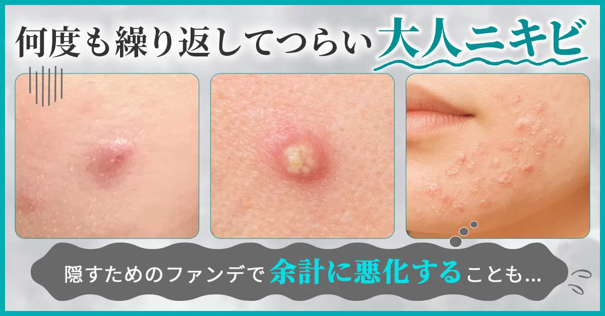 画像に alt 属性が指定されていません。ファイル名: %E3%83%8B%E3%82%AD%E3%83%93%E5%8C%96%E7%B2%A7%E6%B0%B4_%E6%82%A9%E3%81%BF%E5%85%B1%E6%84%9F.webp